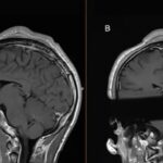 Шишка брейк-дансера