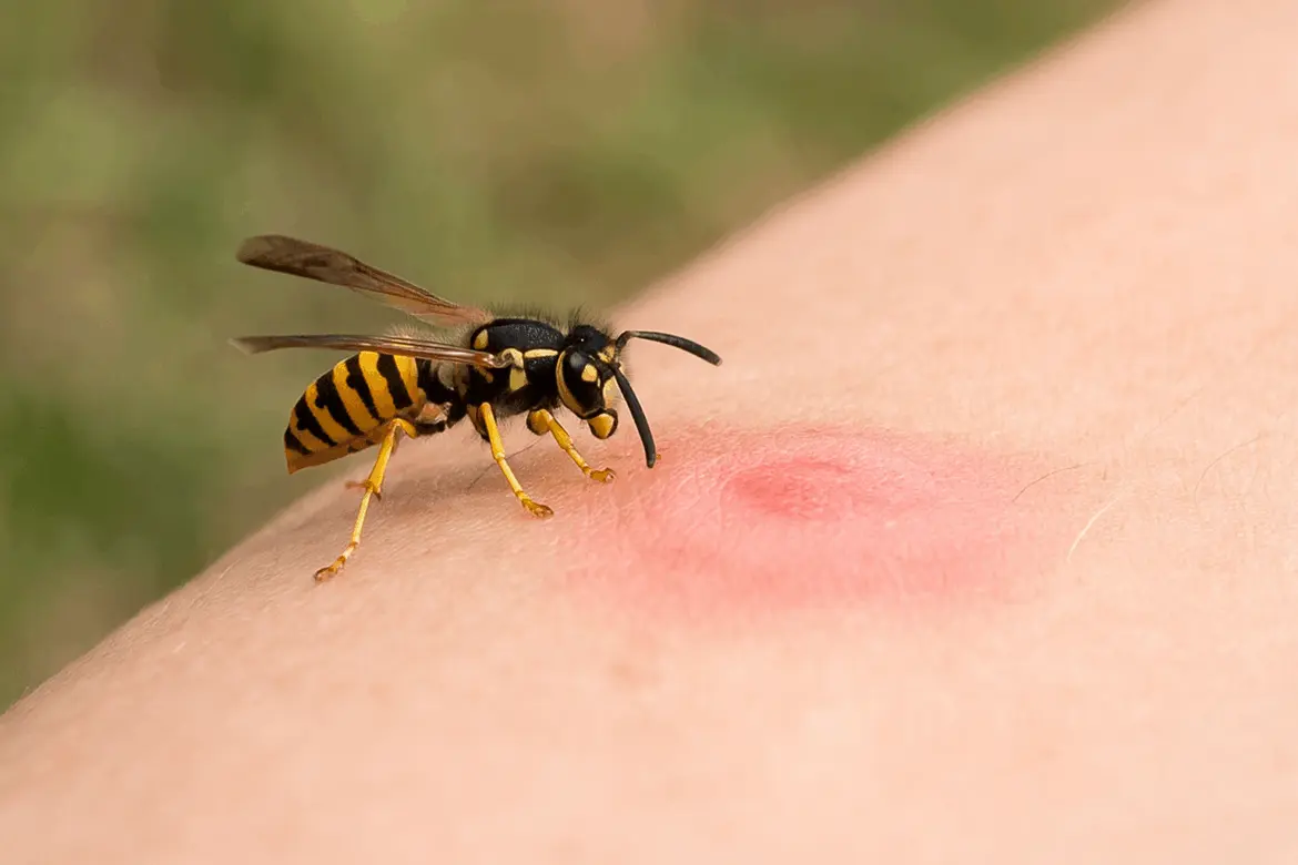 оса кусает человека